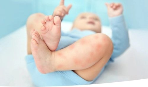 Как выглядит аллергия у новорожденных Image #1