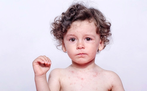 Всегда ли аллергия это сыпь на коже? Image #1